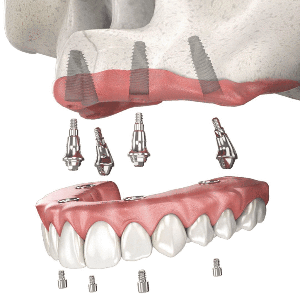 All on 4 impianti dentali arcata totale