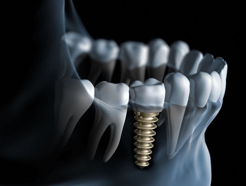 Implantologia dentale con vite in bocca.