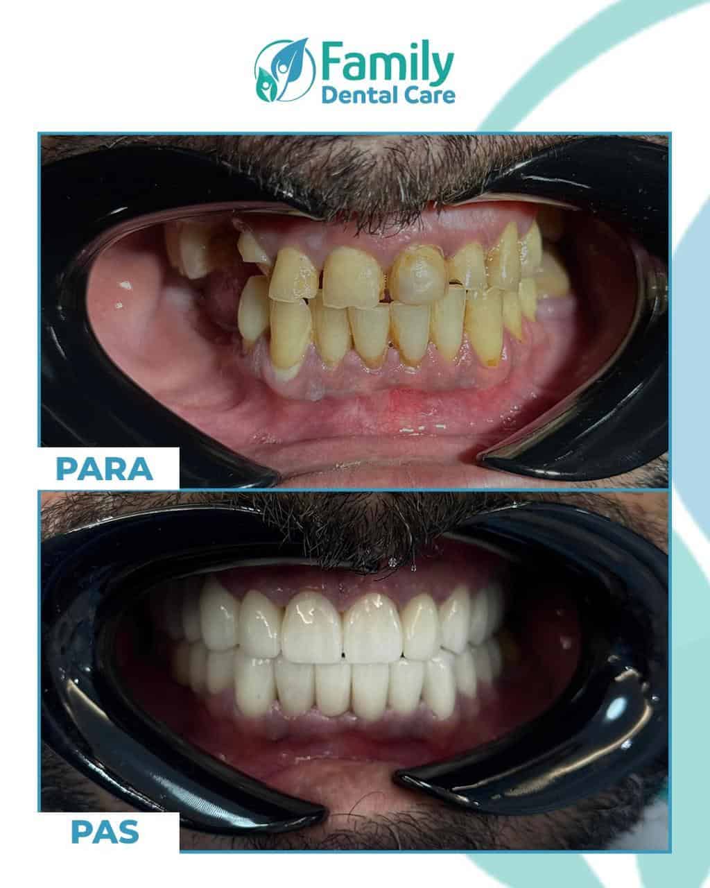 Faccette dentali prima e dopo - restauro completo del sorriso da denti macchiati a sorriso bianco brillante a Tirana Albania