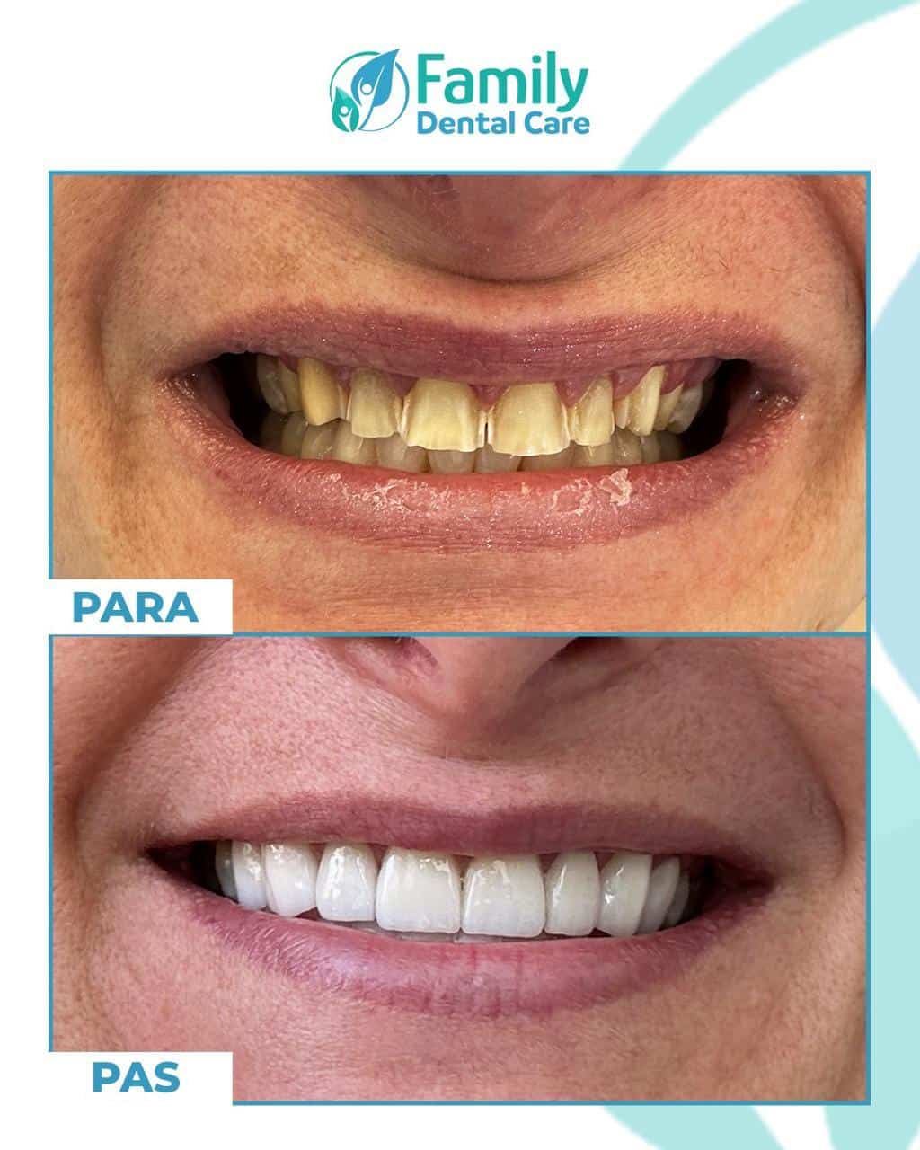 Restauro completo sorriso prima e dopo - correzione denti scoloriti e con spazi mediante faccette dentali e trattamento estetico