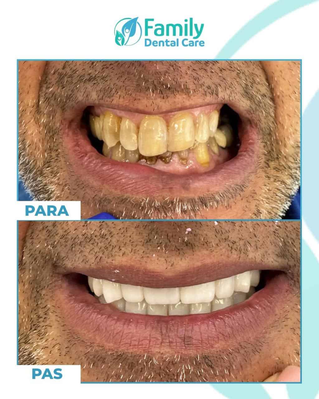 Rifacimento dentale estremo paziente uomo prima dopo - denti ingialliti e macchiati trasformati con corone e faccette dentali