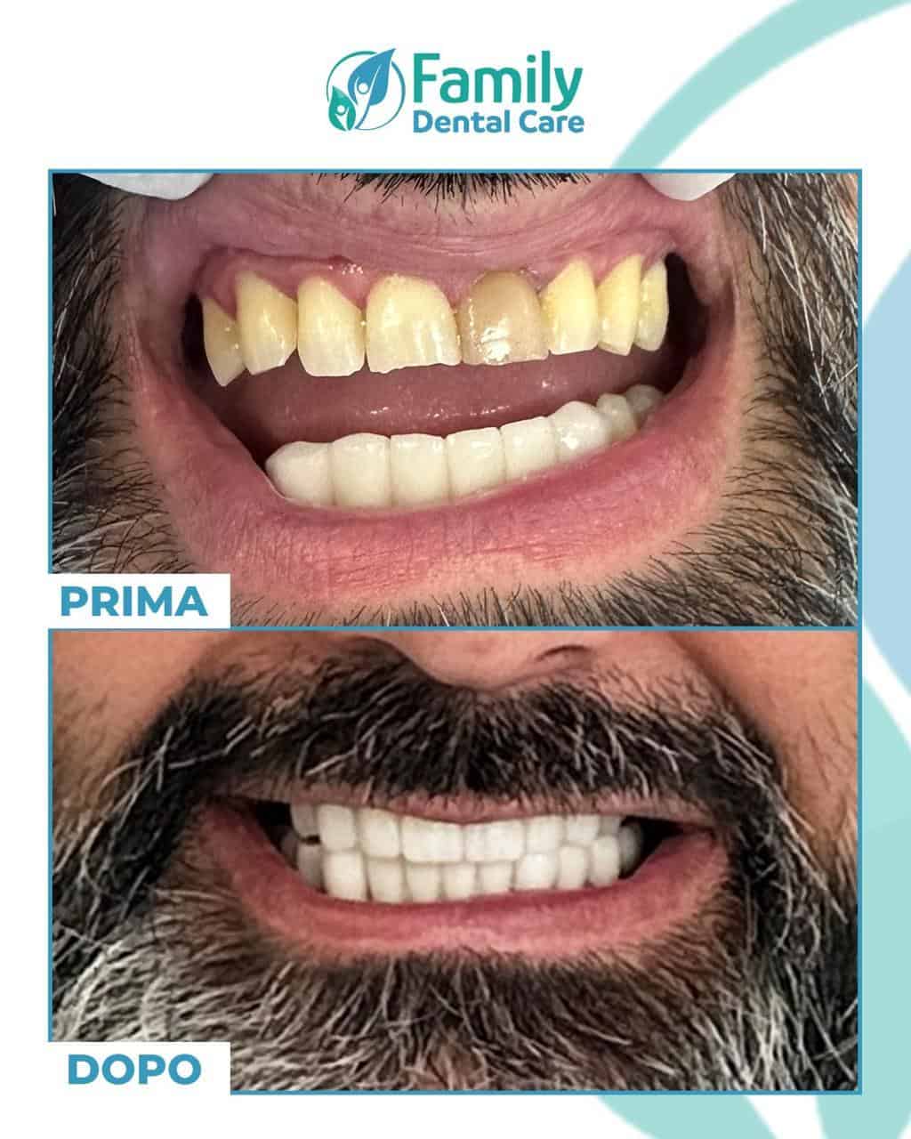 Rifacimento sorriso paziente uomo prima e dopo - trattamento dentale estetico che trasforma denti scoloriti in sorriso bianco naturale