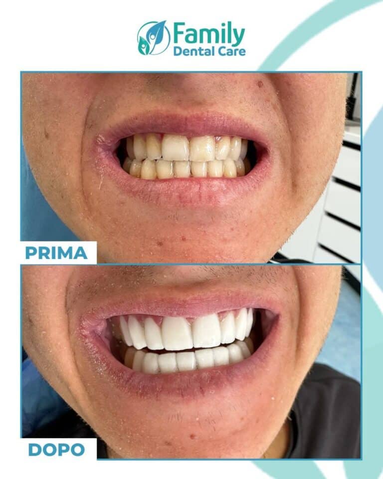 Sbiancamento denti e odontoiatria estetica foto prima dopo - trasformazione sorriso drammatica presso Family Dental Care