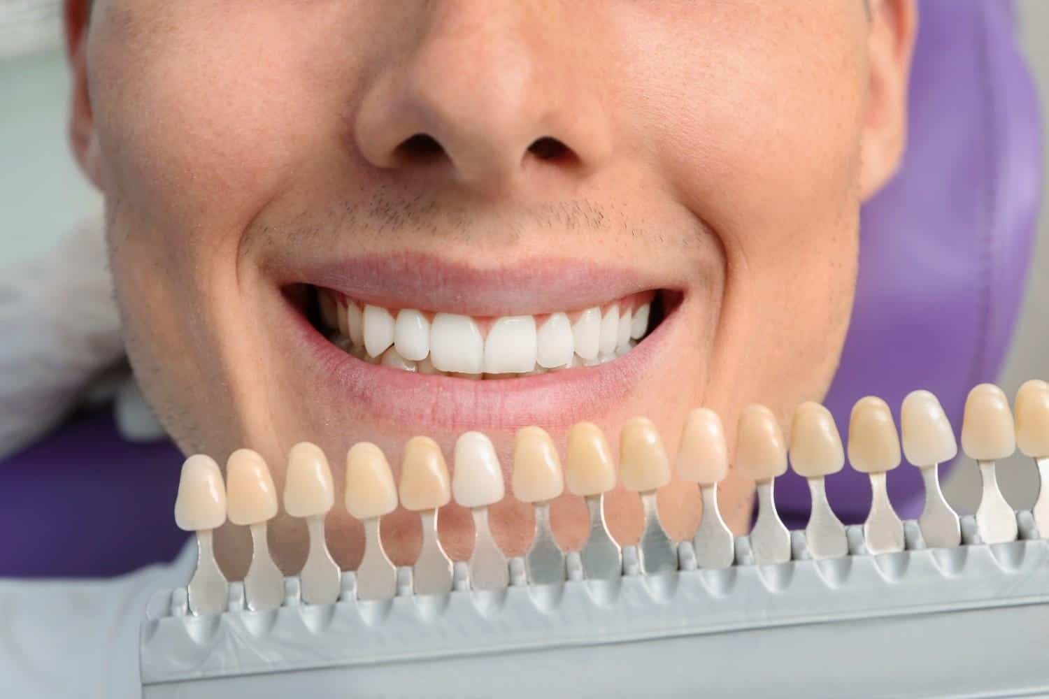 Faccette in porcellana e composito: confronto tra materiali per migliorare il sorriso.