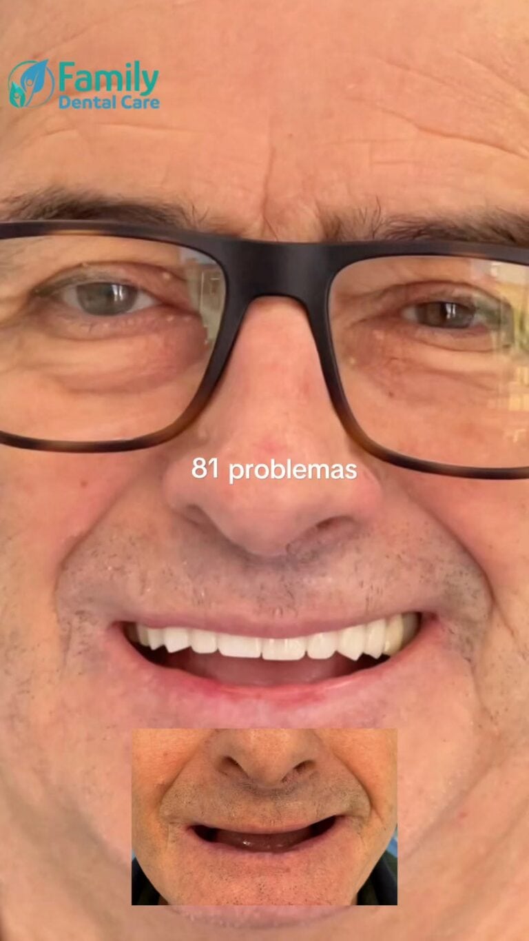 Uomo con occhiali che mostra problemi dentali e gengivali.