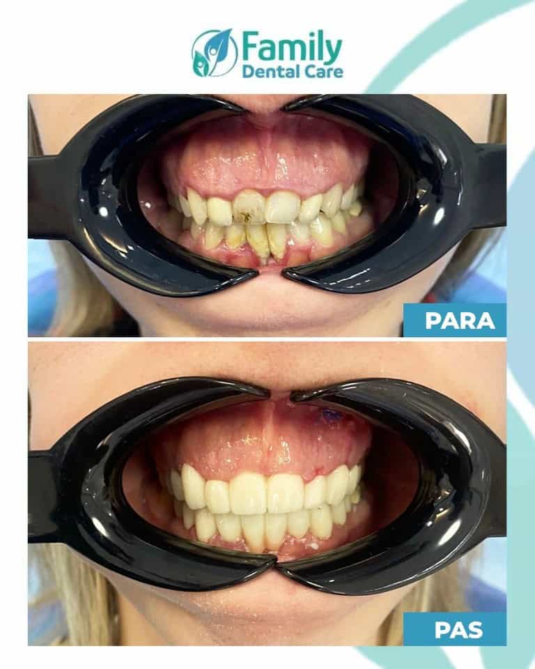 Prima e dopo corone dentali in Albania: restauro estetico del sorriso con forma, colore e allineamento armoniosi