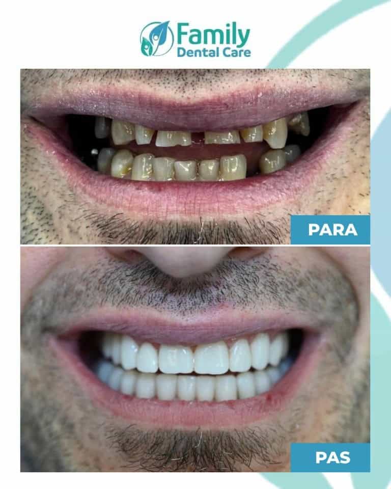 Corone dentali in Albania: miglioramento estetico e funzionale del sorriso con denti più uniformi, bianchi e naturali