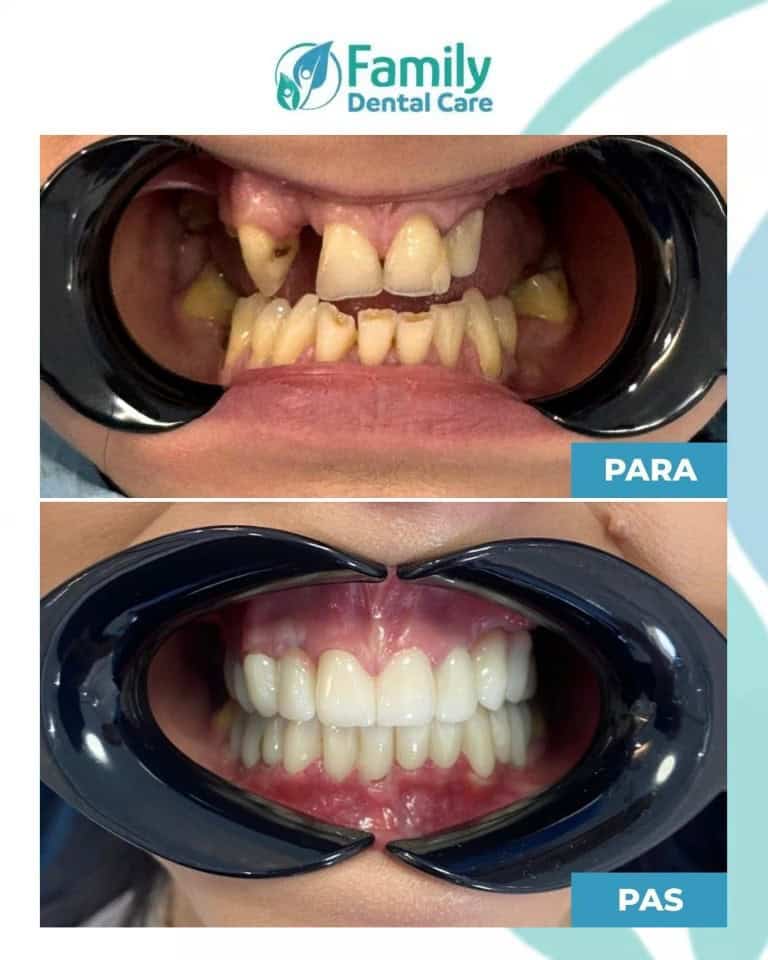 Prima e dopo impianti dentali in Albania: riabilitazione completa del sorriso con risultato naturale e duraturo