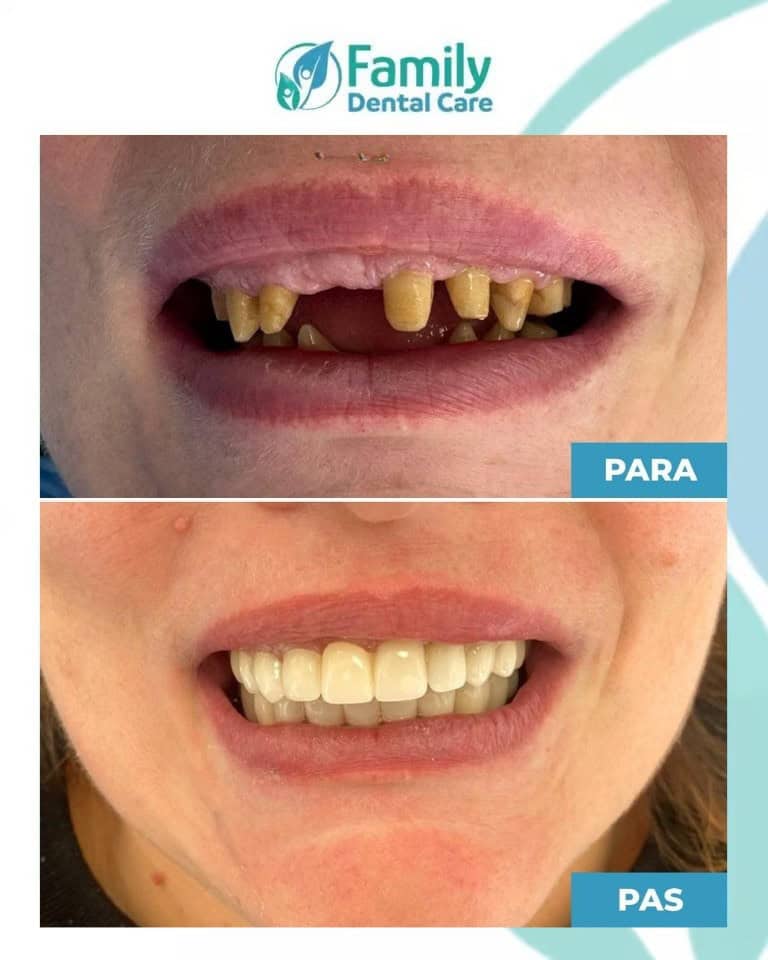 Impianti dentali in Albania: trasformazione prima e dopo con denti fissi