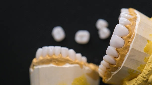 Dental prostheses in resin and ceramic on a study model.