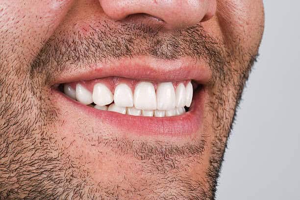 Imagen de una sonrisa con coronas dentales de cerámica y zirconio.