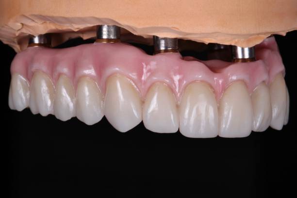 Impianti dentali a carico completo con protesi fissa superiore.