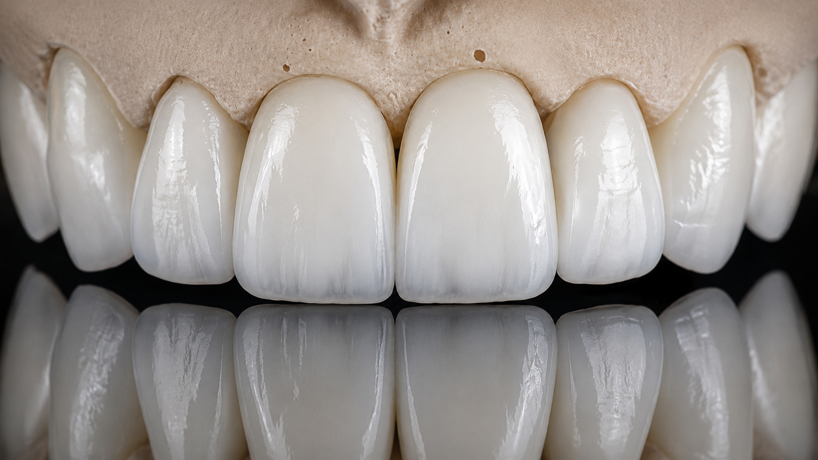 Dents antérieures avec couronnes en céramique blanche et naturelle.
