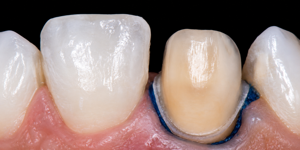 Faccetta in ceramica applicata su un dente naturale.
