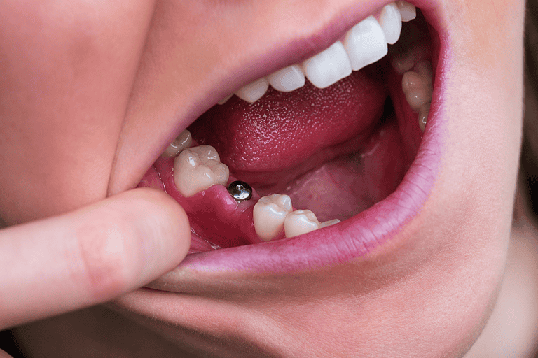 Bambino con impianto dentale in bocca, vista ravvicinata.