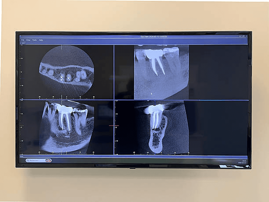 Immagine di uno schermo con radiografie dentali multiple.